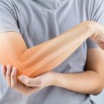 كسور العظام - برفيلكس - brieflex  - برفيلكس - brieflex