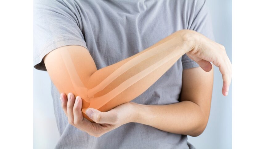 كسور العظام - برفيلكس - brieflex  - برفيلكس - brieflex