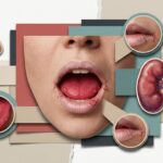 Collage of an open mouth with ulcers, close-up lip and tongue, and a kidney diagram, illustrating oral and kidney health.